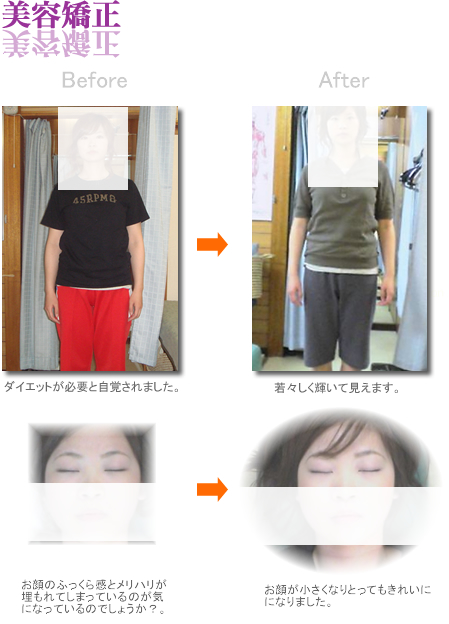O脚矯正の例